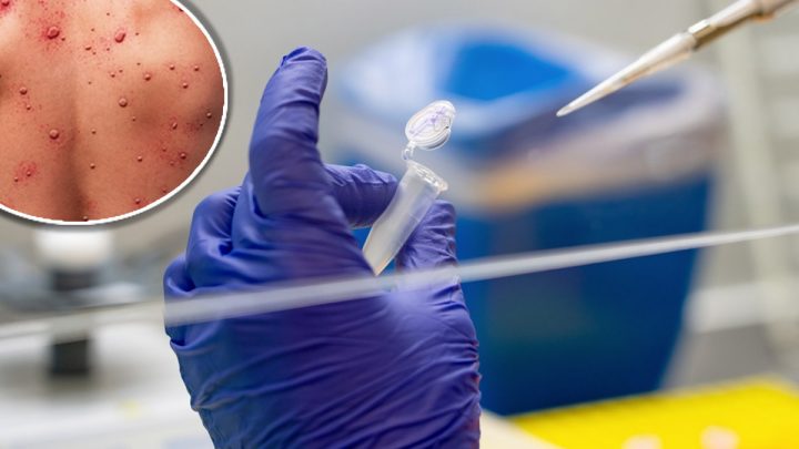 La viruela del mono podría convertirse en una enfermedad de transmisión sexual en EEUU